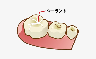 世田谷区千歳烏山の歯医者・矯正歯科「千歳烏山交番通り歯科」|シーラント